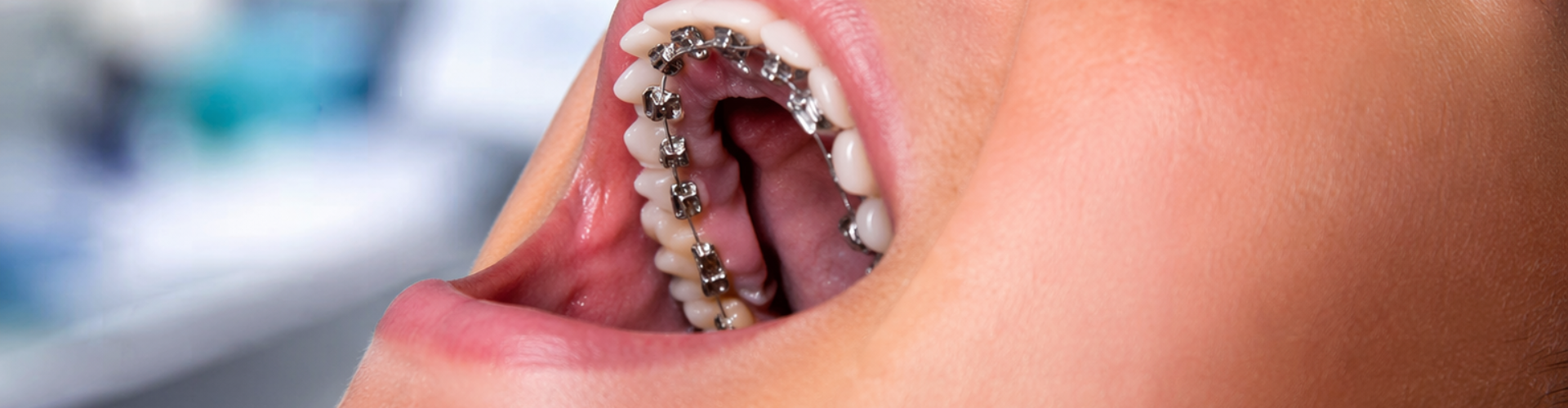 Woman opening her mouth to show braces on the back of her top teeth.